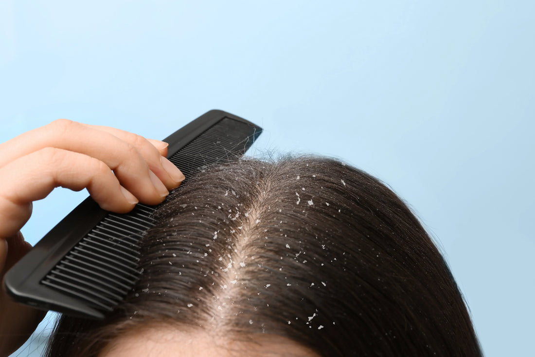 Dandruff Treatment Guide